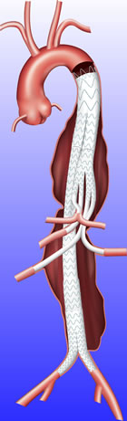 Medtronics Valiant TAAA Stent Graft